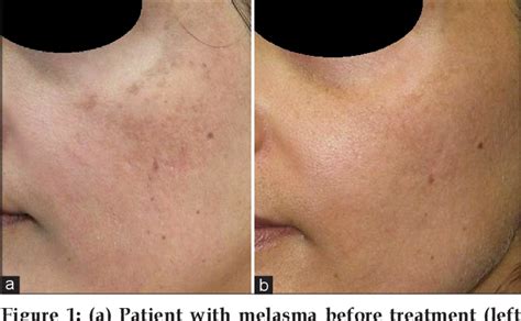 Figure 1 from Lasers for Treatment of Melasma and Post-Inflammatory ...