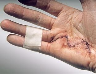 Dupuytren's Contracture Surgery and Recovery