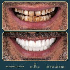 130 Hollywood smile Before and After ideas | smile makeover, smile ...