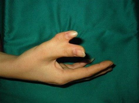 Polydactyly is a genetic condition that causes people to have extra fingers and toes. | Disease ...