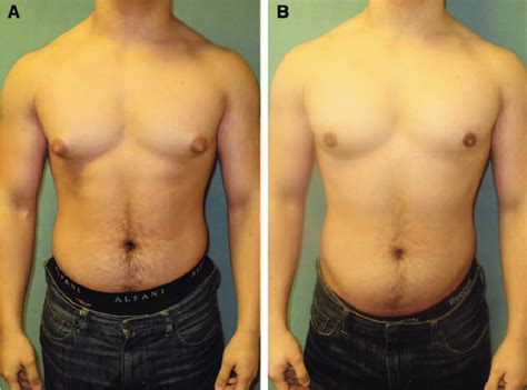 Gynecomastia Liposuction Surgery