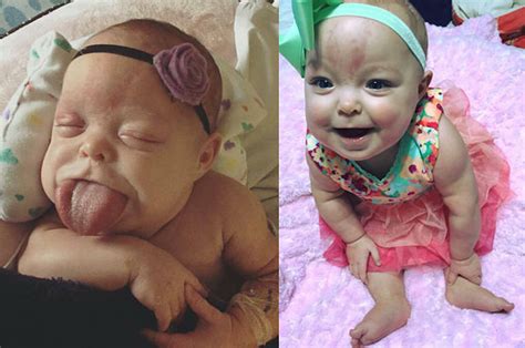 This Baby Born With An Adult-Sized Tongue Can Finally Smile After Surgery