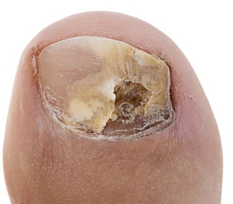 Why Do I Have Horizontal Ridges on My Toenail? [A Dent in My Toenail?]