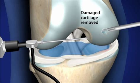 Chondroplasty - Arthroscopic Surgery