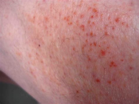 Rash 36 Common Skin Rashes Pictures Causes Treatment - vrogue.co