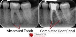 Endodontics - Root Canal - Coronation Dental Specialty Group