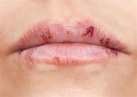 Will Shingles Occur in the Mouth? - InstantKarmaYoga