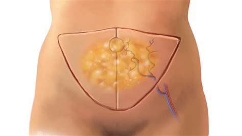 Types Of Breast Flap Surgery - Design Talk