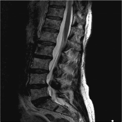 MRI of spine with contrast showing diffusely abnormal marrow signal... | Download Scientific Diagram