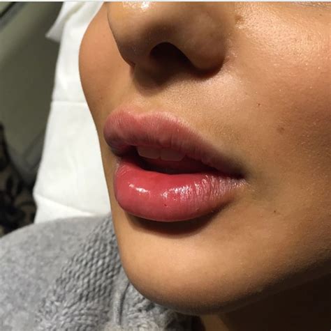 Perfect lip fillers … | Perfect lips, Lip fillers, Lip fillers juvederm