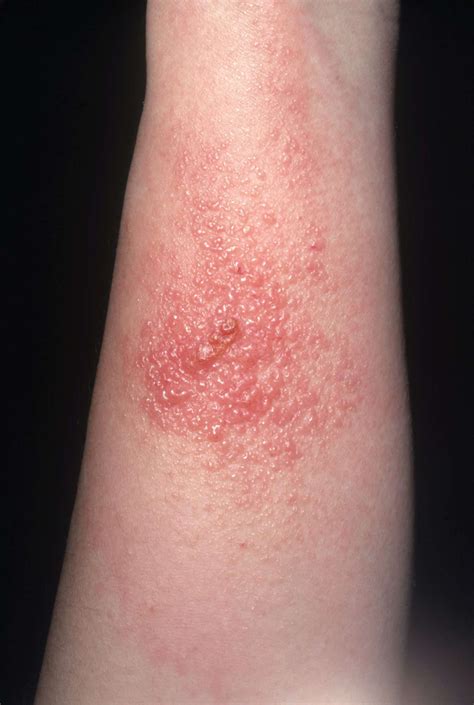 What Does Rash From Poison Oak Look Like - vrogue.co