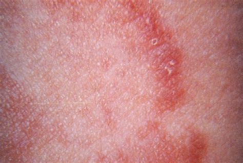 Fungal Skin Infection Of Many Colors Tinea Versicolor Pathogenesis | Images and Photos finder