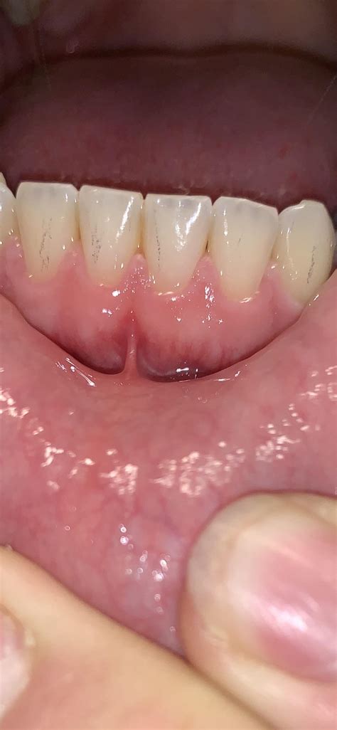 Strange black “veins” on teeth. Disappear with pressure. : r/Dentistry