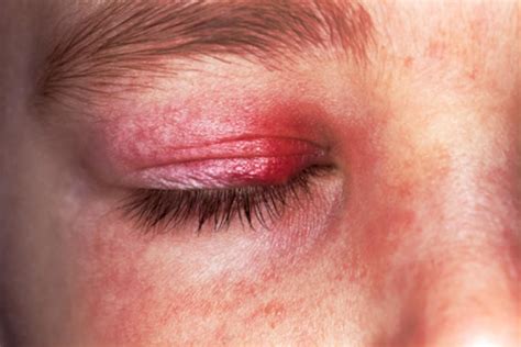 Eyelid Dermatitis