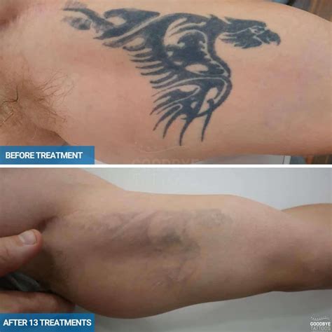 Aggregate 58+ black tattoo laser removal - in.coedo.com.vn