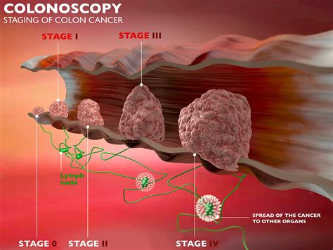 war Ooze Definitive colonoscopy pictures of colon cancer wrench ...