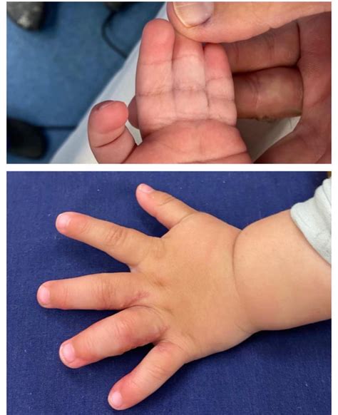 Congenital Hand Surgeon | Dr Lewis Blennerhassett in Subiaco