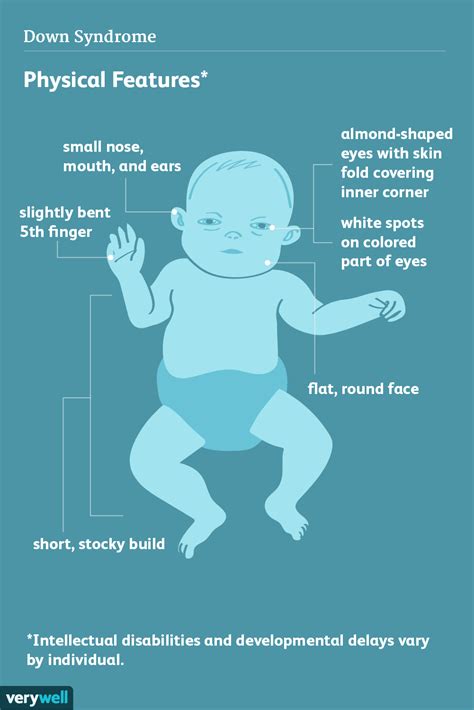 Symptoms and Characteristics of Down Syndrome