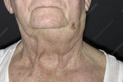 Swollen lymph node due to cancer - Stock Image - M131/0740 - Science Photo Library