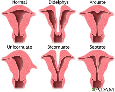 Congenital uterine anomalies: MedlinePlus Medical Encyclopedia Image