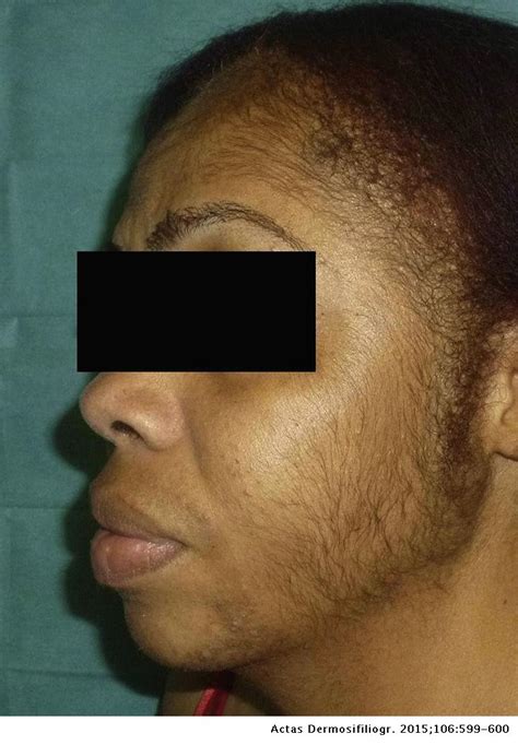 Generalized Hypertrichosis Due to Topical Minoxidil | Actas Dermo-Sifiliográficas