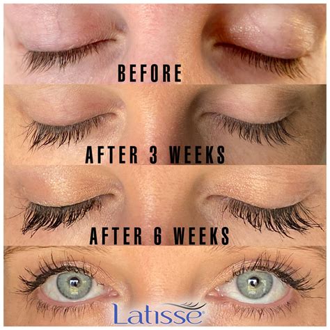 Latisse Before And After 4 Weeks