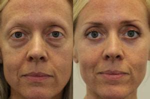 Eye Bags Surgery Lower Blepharoplasty Before After Photos New | Sexiz Pix