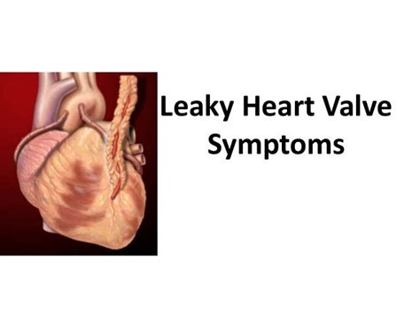 Asian Heart Institute - Leaky heart valve symptoms