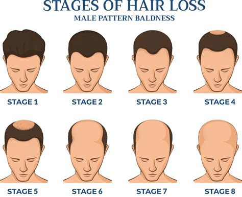 Hair Loss in Men | Male Hair Loss | Cranial Prosthesis Center