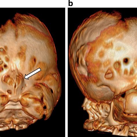 -Three-dimensional reformatted image of the CT in Fig. 1 viewed from ...