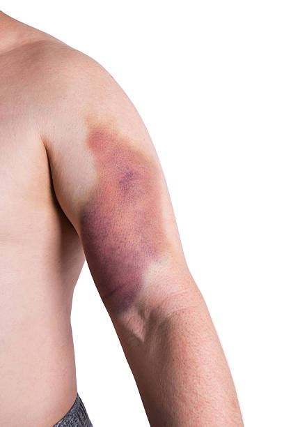 Hemorrhage Bruise Human Arm Physical Injury Stock Photos, Pictures & Royalty-Free Images - iStock