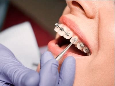 How Orthodontics Can Help Treat Hypodontia | Icon Orthodontics Surprise AZ