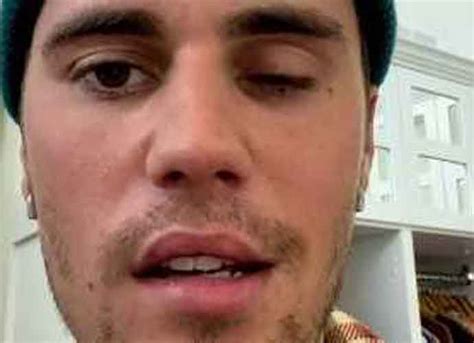 Justin Bieber Smiles In Video Showing Facial Paralysis Recovery From ...