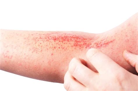 What is Dermatitis?