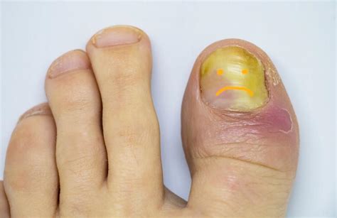 Get Rid of That Toenail Fungus Before Summer: California Foot and Ankle ...