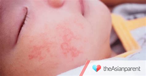 How To Identify, Treat, And Prevent Heat Rash Or Prickly Heat