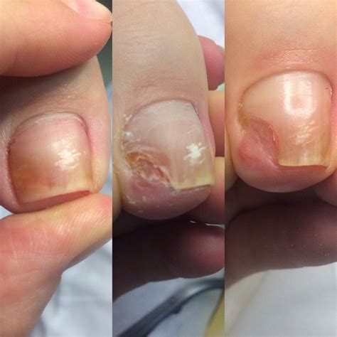 The appearance of onycholysis after gel polish (10 photos): treatment ...