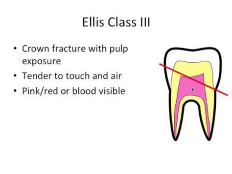 Tooth Trauma- Ellis Classification - YouTube