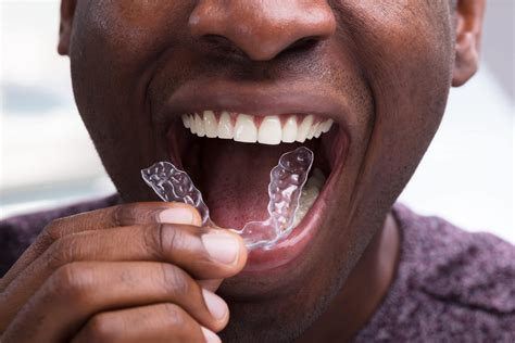 Invisalign London | Invisible Braces London | Ten Dental