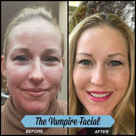 Vampire Facelift vs Vampire Facial: What's the Difference? - Beverly Hills RN