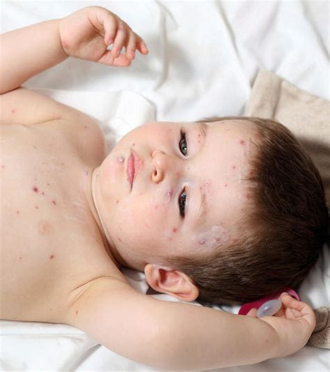 Scabies In Toddlers – Causes, Symptoms & Treatments You Should Be Aware Of