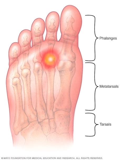 Metatarsalgia or Foot Pain - The Orthobiologic Clinic