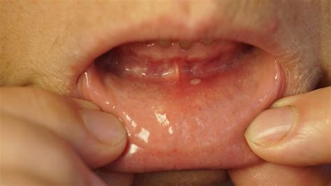 Medications That Can Cause Burning Mouth Syndrome and More - GoodRx