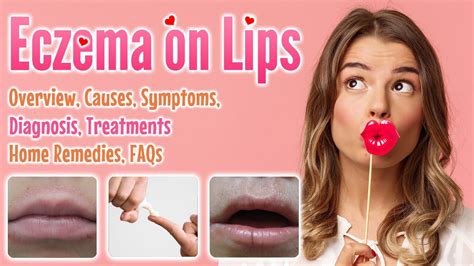 Eczema on lips overview, causes, sign and symptoms, diagnosis, treatment, home remedies and FAQs ...