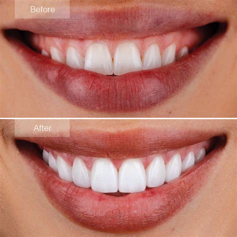 Porcelain Veneers Before and After - The Dental Room