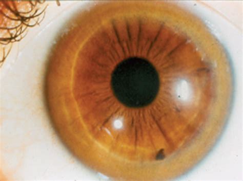 Corneal Manifestations of Systemic Diseases | Consultant360