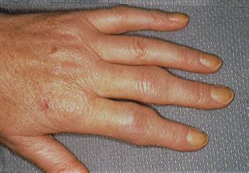 Arthritis Hands Early Signs