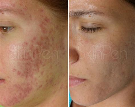 Professional Red Acne Scars Treatment Brisban - Cutis Dermatology