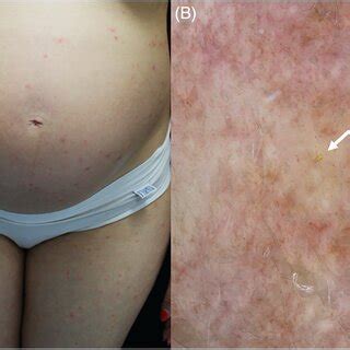 Sharpen your sight: Trombiculosis under the dermatoscope with LC‐OCT new insights | Request PDF