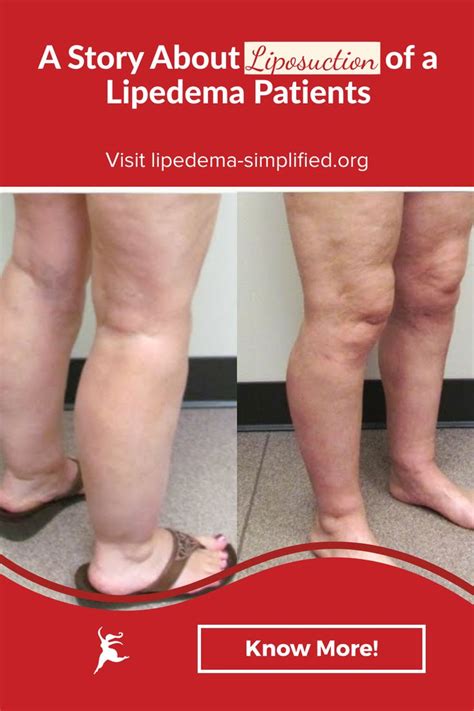 Liposuction Story of a Lipedema Patients in 2021 | Lipedema, Liposuction, Lymphedema